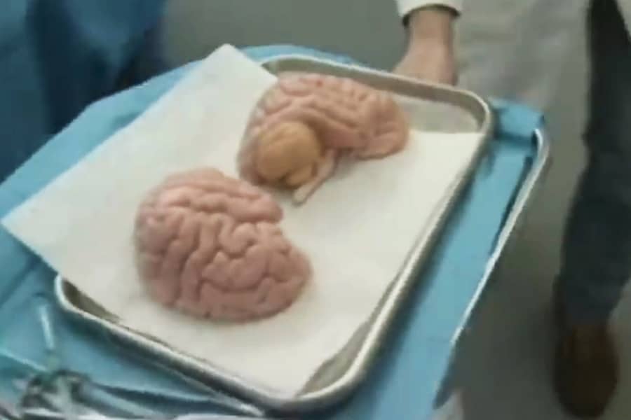 two brains on a surgical tray